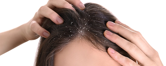 dandruff is a common scalp