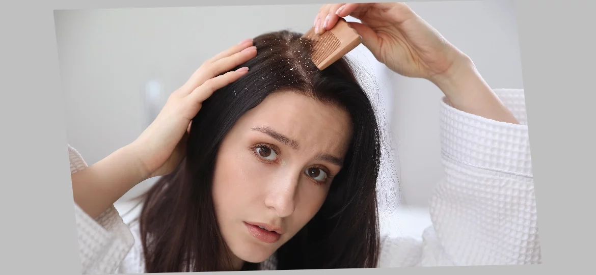 How to Get Rid of Dandruff and Restore Scalp Health